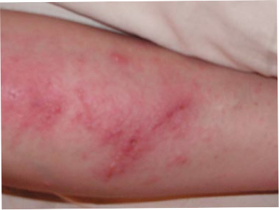 bad poison ivy rashes. systemic poison ivy pictures.
