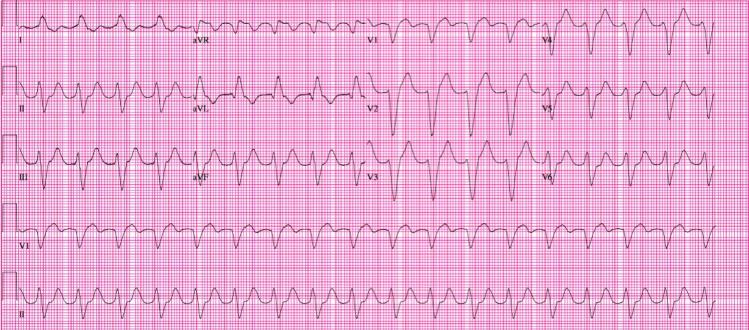 abnormal EKG